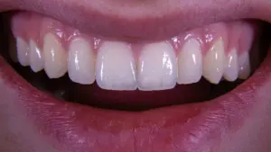 Soñar con perder los dientes: un símbolo entre imagen y cambio